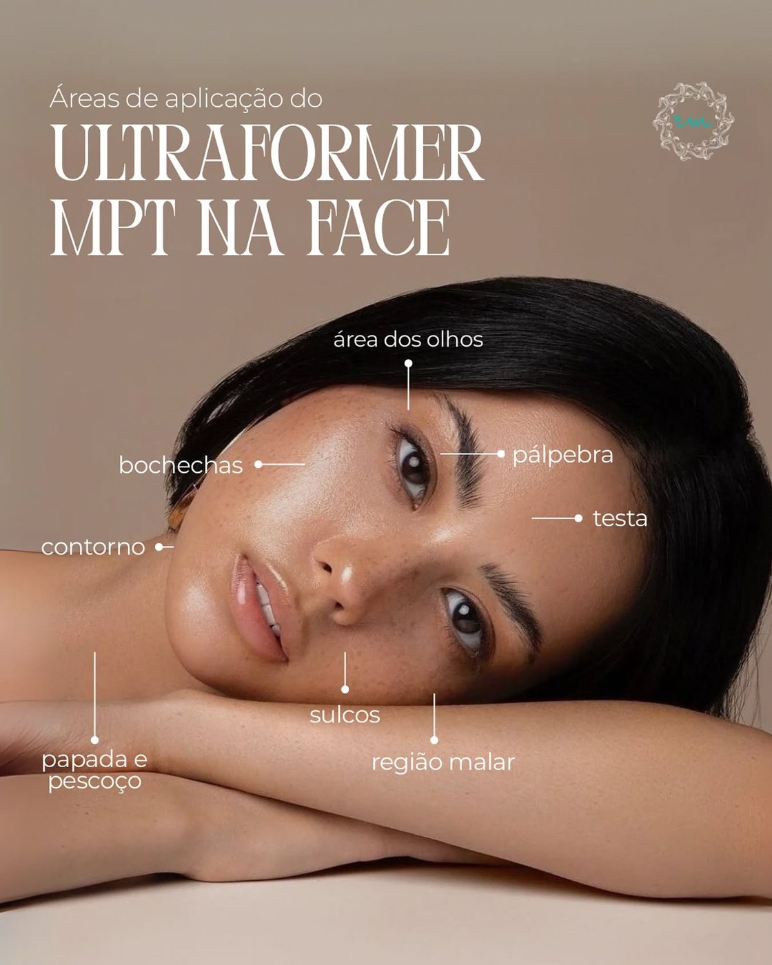 Áreas de aplicação do Ultraformer MPT na face